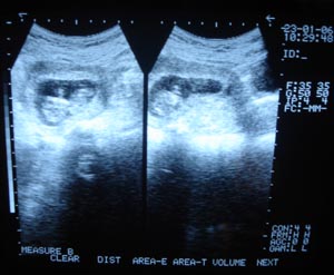 Obstetric Ultrasonography 1st trimester