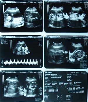 Obstetric Ultrasonography 2
